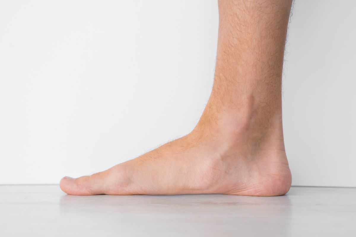 What To Do For Flat Feet? How To Treat This Condition