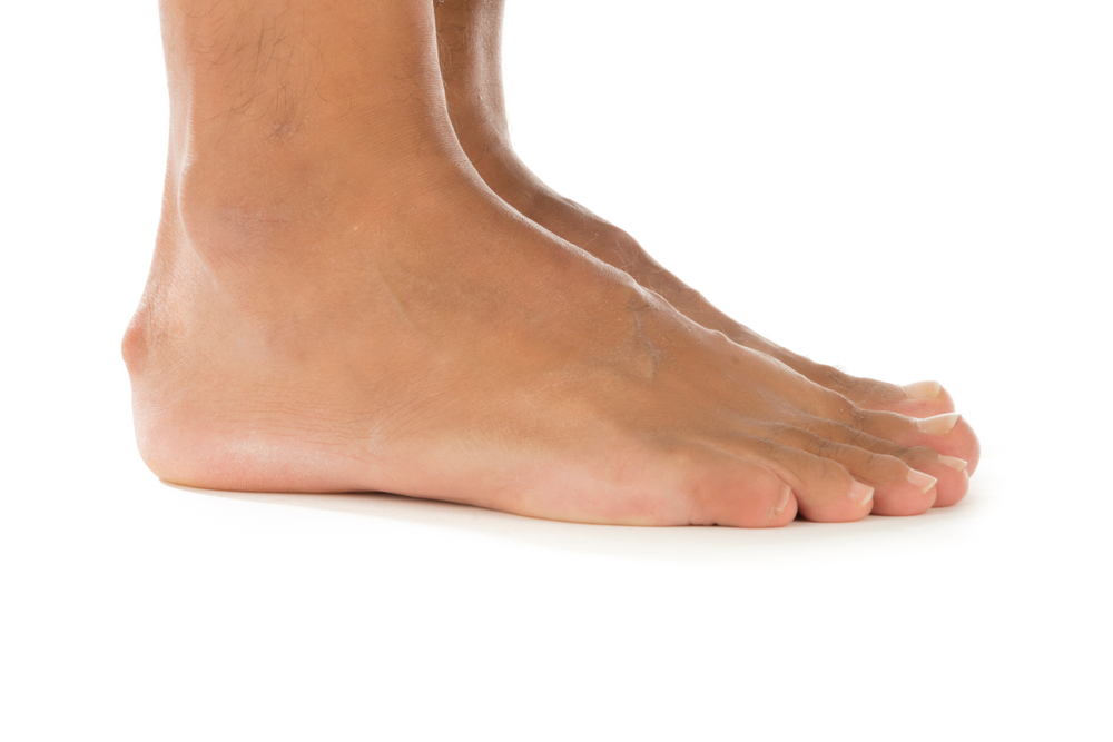 Schuhe für Haglund-Deformitäten: Weg mit Schmerz und Unbehagen